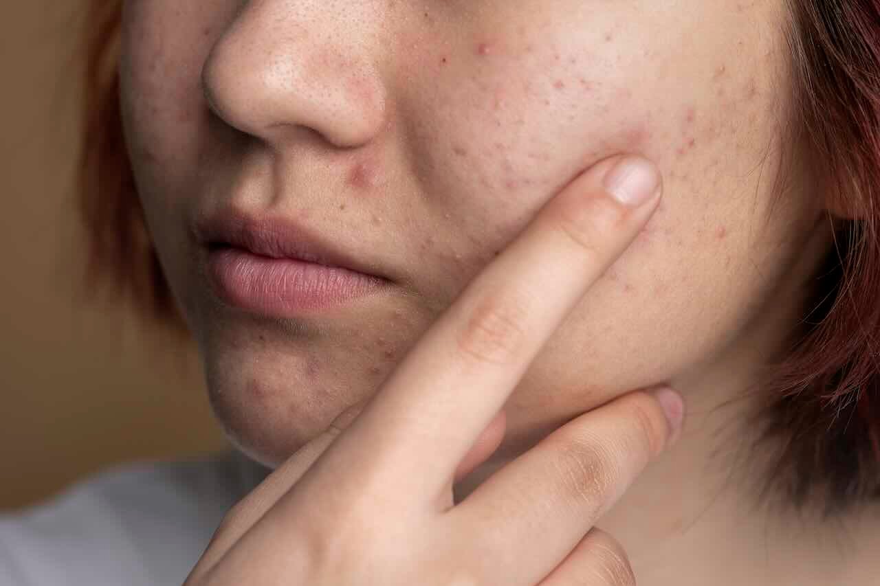 Skin Barrier Rusak? Jangan Cemas, Lakukan 7 Hal Ini!